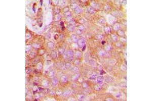 Immunohistochemical analysis of FAM84B staining in human breast cancer formalin fixed paraffin embedded tissue section. (FAM84B anticorps  (N-Term))