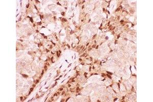 IHC-P: RUNX1 antibody testing of human breast cancer tissue (RUNX1 anticorps  (Middle Region))
