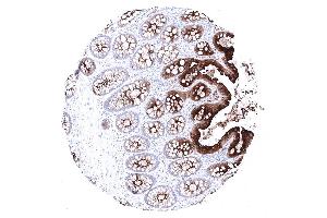 Moderate to strong CEA immunostaining in the epithelial cells of the colon.