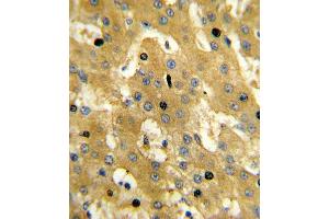 Formalin-fixed and paraffin-embedded human hepatocarcinoma reacted with SCP2 Antibody (Center), which was peroxidase-conjugated to the secondary antibody, followed by DAB staining. (SCP2 anticorps  (AA 358-385))
