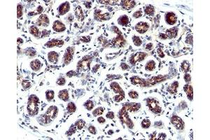 IHC staining of human breast cancer with Estrogen Inducible Protein pS2 antibody. (TFF1 anticorps  (C-Term))