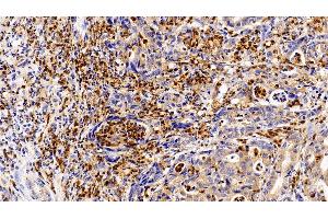 Detection of GCSFR in Human Stomach cancer Tissue using Polyclonal Antibody to Colony Stimulating Factor Receptor, Granulocyte (GCSFR)