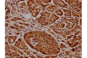 IHC image of ABIN7148861 diluted at 1:600 and staining in paraffin-embedded human pancreatic cancer performed on a Leica BondTM system. (CDK17 anticorps  (AA 337-523))