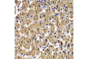 Immunohistochemistry of paraffin-embedded human liver cancer using MMP14 antibody. (MMP14 anticorps)