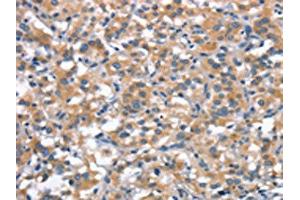 The image on the left is immunohistochemistry of paraffin-embedded Human thyroid cancer tissue using ABIN7189813(ANP32C Antibody) at dilution 1/30, on the right is treated with synthetic peptide. (ANP32C anticorps)