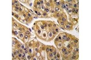 IHC analysis of FFPE human hepatocarcinoma tissue stained with IDH1 antibody (IDH1 anticorps  (AA 116-143))