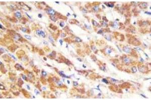Immunohistochemistry (IHC) analyzes of Bax antibody in paraffin-embedded human liver carcinoma tissue. (LGALS7 anticorps)