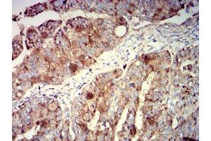 Immunohistochemical analysis of paraffin-embedded rectum cancer tissues using CD63 mouse mAb with DAB staining.
