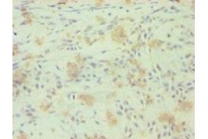 Immunohistochemistry of paraffin-embedded human breast cancer using ABIN7161881 at dilution of 1:100 (RORC anticorps  (AA 1-518))
