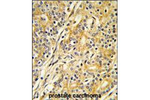 Formalin-fixed and paraffin-embedded human prostate carcinoma reacted with CYP51A1 Antibody , which was peroxidase-conjugated to the secondary antibody, followed by DAB staining. (CYP51A1 anticorps  (C-Term))