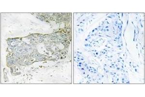 Immunohistochemistry analysis of paraffin-embedded human breast carcinoma tissue, using FA7 (light chain,Cleaved-Arg212) Antibody. (Factor VII anticorps  (Cleaved-Arg212))