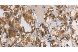 Immunohistochemistry of paraffin-embedded Human thyroid cancer tissue using DUSP26 Polyclonal Antibody at dilution 1:60 (DUSP26 anticorps)