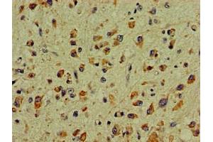 Immunohistochemistry of paraffin-embedded human glioma using ABIN7169039 at dilution of 1:100