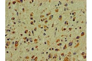 Immunohistochemistry of paraffin-embedded human glioma using ABIN7169039 at dilution of 1:100 (DCLK1 anticorps  (AA 143-381))