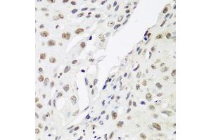 Immunohistochemistry of paraffin-embedded human lung cancer using CBX3 antibody at dilution of 1:200 (40x lens). (CBX3 anticorps)