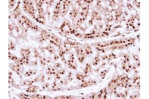 IHC-P Image Immunohistochemical analysis of paraffin-embedded human breast cancer, using ZNF323, antibody at 1:250 dilution. (Zinc Finger and SCAN Domain Containing 31 (ZSCAN31) (Center) anticorps)