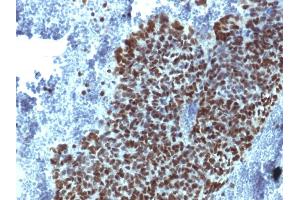 Formalin-fixed, paraffin-embedded human Prostate Carcinoma stained with FOXA1 Monoclonal Antibody (FOXA1/1514). (FOXA1 anticorps  (AA 372-472))