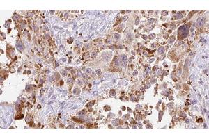 ABIN6273251 at 1/100 staining Human Melanoma tissue by IHC-P. (GREM2 anticorps  (Internal Region))