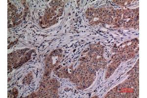 Immunohistochemistry (IHC) analysis of paraffin-embedded Human Breast Cancer, antibody was diluted at 1:100. (IL-4 anticorps  (Internal Region))