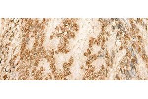 Immunohistochemistry of paraffin-embedded Human colorectal cancer tissue using HIST1H2BA Polyclonal Antibody at dilution of 1:45(x200) (HIST1H2BA anticorps)