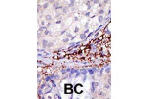 Formalin-fixed and paraffin-embedded human cancer tissue reacted with RNF216 polyclonal antibody  , which was peroxidase-conjugated to the secondary antibody, followed by DAB staining. (RNF216 anticorps  (C-Term))