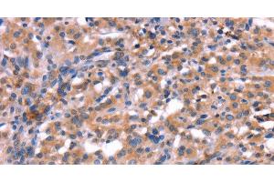 Immunohistochemistry of paraffin-embedded Human thyroid cancer using HMGCS1 Polyclonal Antibody at dilution of 1:40 (HMGCS1 anticorps)