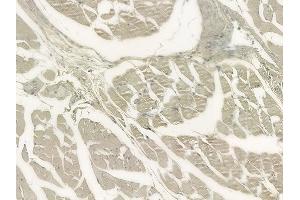 ABIN6264555 and ABIN6273303 at 1/100 staining human lung adenocarcinoma by IHC-P. (RAB12 anticorps  (C-Term))