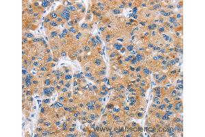 Immunohistochemistry of Human liver cancer using DKK2 Polyclonal Antibody at dilution of 1:60 (DKK2 anticorps)