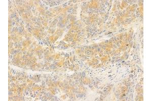 ABIN6260379 and ABIN6276678 at 1/100 staining human lung squamous cell carcinoma by IHC-P.