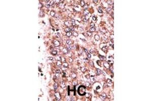 Formalin-fixed and paraffin-embedded human cancer tissue reacted with the primary antibody, which was peroxidase-conjugated to the secondary antibody, followed by DAB staining.