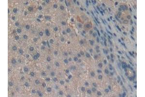 Detection of Slit2 in Human Liver cancer Tissue using Polyclonal Antibody to Slit Homolog 2 (Slit2) (SLIT2 anticorps  (AA 1416-1528))
