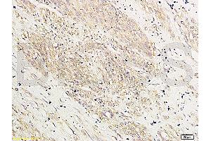 Formalin-fixed and paraffin-embedded: human breast cancer labeled with Rabbit Anti-HOXA10 Polyclonal Antibody (ABIN741195) , Unconjugated 1:200 followed by conjugation to the secondary antibody and DAB staining