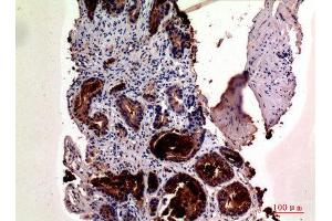Immunohistochemistry (IHC) analysis of paraffin-embedded Human Prostate Cancer, antibody was diluted at 1:100. (Prostate Specific Antigen anticorps  (Internal Region))
