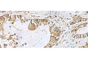 Immunohistochemistry of paraffin-embedded Human gastric cancer tissue using TUBD1 Polyclonal Antibody at dilution of 1:70(x200) (TUBD1 anticorps)