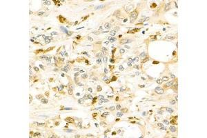 Immunohistochemistry of paraffin embedded human Cholangiocarcinoma using ANXA3 (ABIN7073065) at dilution of 1: 200 (400x lens)