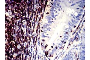 Immunohistochemical analysis of paraffin-embedded rectum cancer tissues using CD11a mouse mAb with DAB staining. (ITGAL anticorps  (AA 26-194))