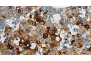 Immunohistochemistry of paraffin-embedded Human breast cancer using LCN2 Polyclonal Antibody at dilution of 1:60 (Lipocalin 2 anticorps)