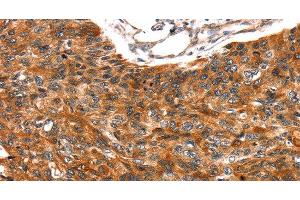Immunohistochemistry of paraffin-embedded Human esophagus cancer tissue using TRIM69 Polyclonal Antibody at dilution 1:40 (TRIM69 anticorps)