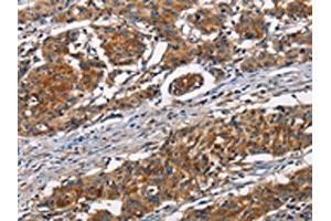 The image on the left is immunohistochemistry of paraffin-embedded Human gastic cancer tissue using ABIN7189936(ATP7A Antibody) at dilution 1/50, on the right is treated with synthetic peptide. (ATP7A anticorps)