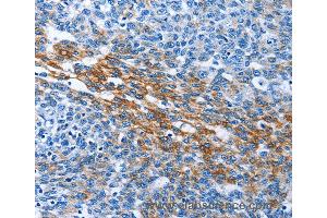 Immunohistochemistry of Human thyroid cancer using PAK6 Polyclonal Antibody at dilution of 1:40 (PAK6 anticorps)