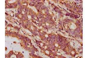 IHC image of ABIN7154549 diluted at 1:132 and staining in paraffin-embedded human colon cancer performed on a Leica BondTM system.