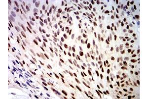 Immunohistochemical analysis of paraffin-embedded esophageal cancer tissues using DDX1 mouse mAb with DAB staining. (DDX1 anticorps  (AA 642-740))