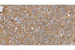 Immunohistochemistry of paraffin-embedded Human ovarian cancer using PTGER2 Polyclonal Antibody at dilution of 1:45 (PTGER2 anticorps)