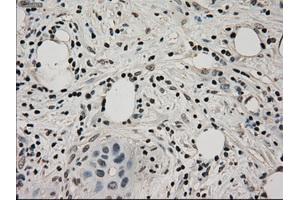 Immunohistochemical staining of paraffin-embedded Adenocarcinoma of ovary tissue using anti-LDHAmouse monoclonal antibody. (Lactate Dehydrogenase A anticorps)
