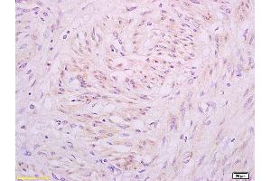 Formalin-fixed and paraffin embedded human cervical carcinoma tissue labeled with Anti A1BG Polyclonal Antibody,Unconjugated (ABIN872952) at 1:200 followed by conjugation to the secondary antibody and DAB staining. (A1BG anticorps  (AA 301-400))