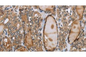 Immunohistochemistry of paraffin-embedded Human thyroid cancer using GGT1 Polyclonal Antibody at dilution of 1:40 (GGT1 anticorps)