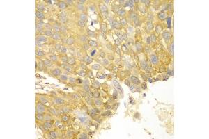 Immunohistochemistry of paraffin-embedded human lung cancer using ACTN1 antibody (ABIN5970506) at dilution of 1/100 (40x lens).
