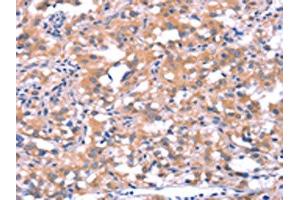 The image on the left is immunohistochemistry of paraffin-embedded Human thyroid cancer tissue using ABIN7190628(FAT1 Antibody) at dilution 1/40, on the right is treated with synthetic peptide. (FAT1 anticorps)