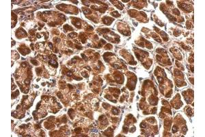 IHC-P Image Pyruvate Dehydrogenase E1 alpha antibody detects PDHA1 protein at cytosol on human hepatoma by immunohistochemical analysis. (Pyruvate Dehydrogenase E1 alpha (Center) anticorps)