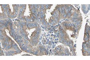 ABIN6274646 at 1/100 staining Human cervical cancer tissue by IHC-P. (CYP2C8 anticorps)